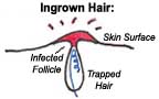 infected_ingrown_hairs_pictures
