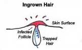 treating_preventing_ingrown_hair