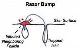 ingrown_hair